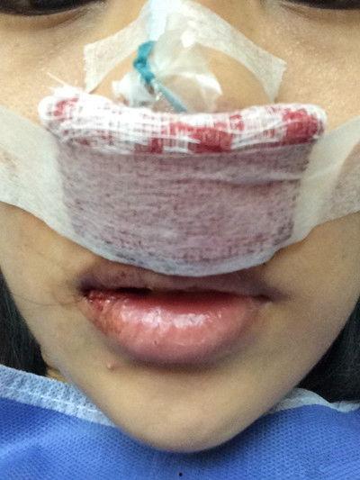 鼻子溃烂图片,病因、症状及防治策略