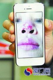 鼻子溃烂图片,病因、症状及防治策略